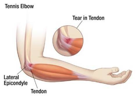 tennis-elbow-injury-table-tennis tennis elbow injury table tennis